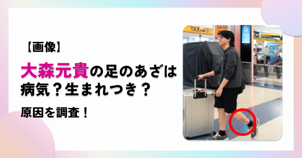 ミセス大森元貴の足のあざは病気？生まれつき？原因を調査